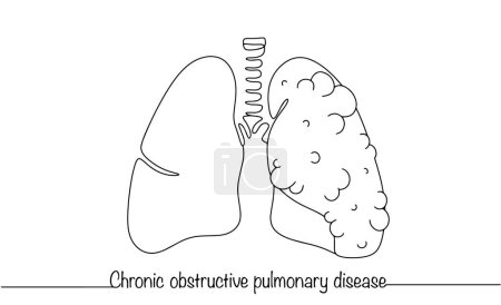 Un pulmón sano y el segundo con signos de enfermedad. Enfermedad pulmonar obstructiva crónica. Ilustración de línea simple para diferentes usos.