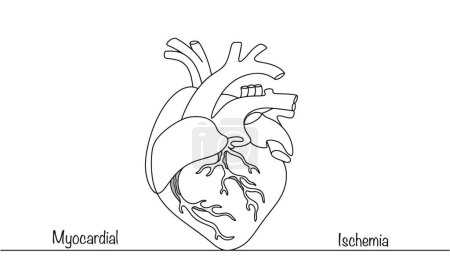 The heart of a person with ischemia. Changes in the functioning of the heart vessels due to their narrowing. Line medical illustration for different widows of use.