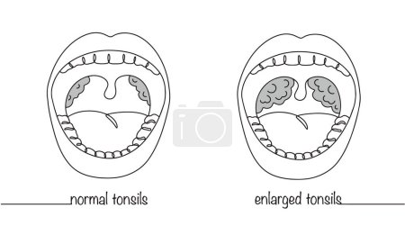 Boca abierta con amígdalas visibles. Amígdalas humanas normales e inflamadas. Ilustración de línea simple. Vector aislado sobre fondo blanco.