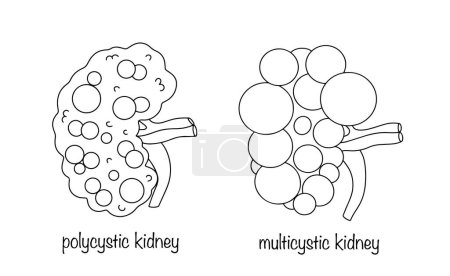 Rein polykystique et rein multicystique. Illustration visuelle des changements dans le rein humain avec différents kystes. Vecteur noir et blanc.