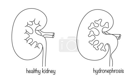 A healthy kidney and a kidney with hydronephrosis. Pathological expansion of the kidney-lobe system. Accumulation of excess fluid in the kidney. Vector illustration.