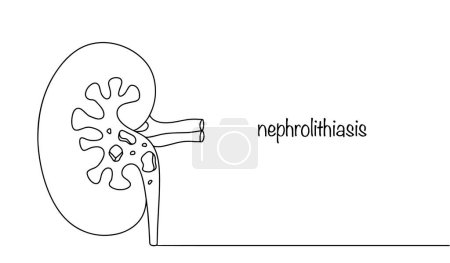 Illustration for A human bone with formed stones. The second most common disease among all kidney diseases. Vector. - Royalty Free Image