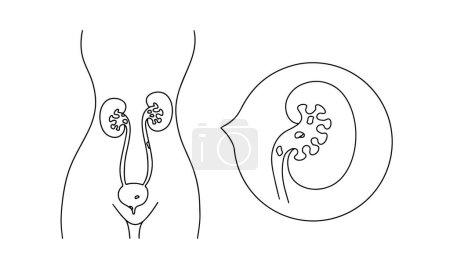 Ilustración de Una mujer con una enfermedad renal. La formación de cálculos renales se forma debido a trastornos metabólicos en el sistema urinario. ilustración médica. - Imagen libre de derechos
