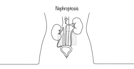 Ein pathologischer Zustand, bei dem die Niere nach unten verschoben wird. Einfache Linienillustration auf weißem Hintergrund.