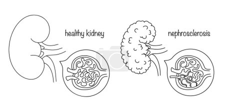 A healthy kidney and a kidney with nephrosclerosis. Kidney damage, which consists in reducing its size and gradually replacing it with fibrous tissue. Medical illustration for different uses.