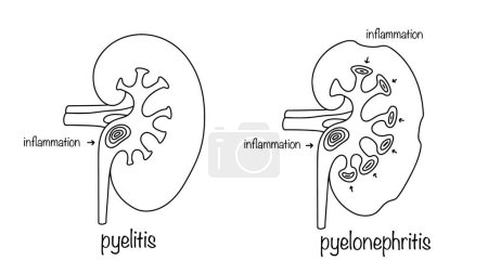 Pyelitis and pyelonephritis. Inflammatory disease of infectious origin. Simple illustration by hand. Medical education.