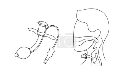 Tracheostomie und ein Mann mit einer Tracheostomie. Eine Operation zur Schaffung einer chirurgischen Öffnung in der Luftröhre, um das Atmen zu erleichtern. Vektorillustration