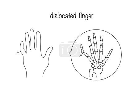 Mano con un dedo meñique dislocado. Afección patológica en la que se desplazan las superficies articulares. Lesión que requiere intervención médica. Ilustración vectorial.