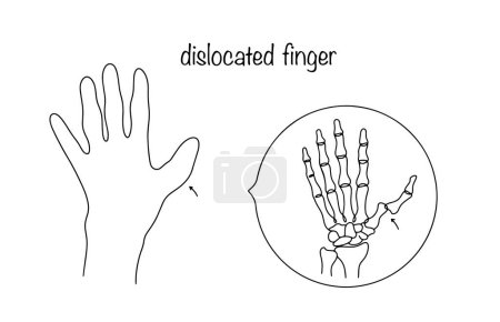 Mano con pulgar dislocado. Desplazamiento de la falange del dedo como resultado de una lesión. Ilustración dibujada a mano.
