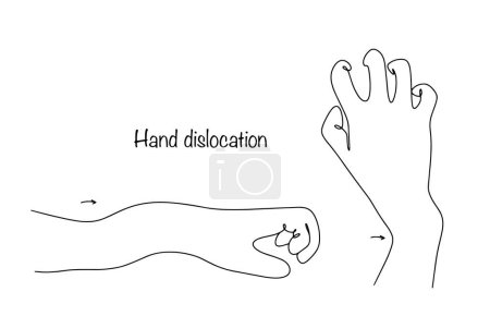Illustration for Various dislocations of the human wrist. Displacement of joints as a result of traumatic impact. Isolated vector on white background. - Royalty Free Image