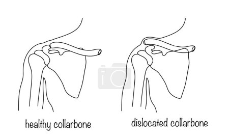Correct and incorrect position of the collarbone in the body. Dislocated collarbone. Deviation from the normal position of the bone in the sternal segment. Medical vector illustration.