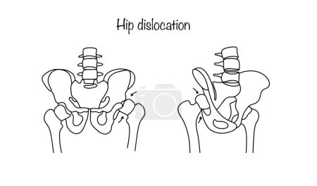 Dislocación de cadera humana. Violación de la posición del fémur en la articulación de la cadera. Línea dibujada ilustración médica.