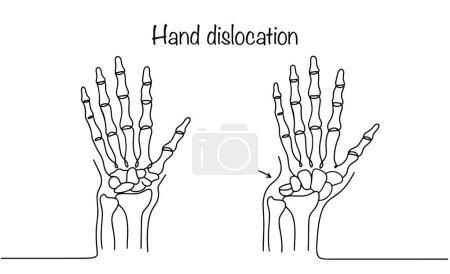 Eine gesunde menschliche Hand und eine Hand mit einer Verrenkung im Handgelenkbereich. Ein unnatürlicher Zustand, in dem es zu einer Verschiebung der Gelenkoberflächen kommt. Vektorillustration.