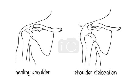 Gesunde Schulter und ausgekugelte Schulter. Prolaps des Oberarmkopfes aus der Glenoidhöhle. Illustration zu einem medizinischen Thema. 