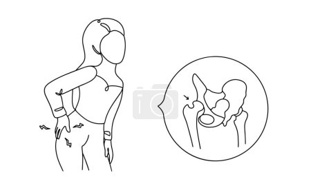 Illustration for The woman is holding her hip. Severe pain in the hip. Hip dislocation. Simple line illustration on a white background. Vector. - Royalty Free Image