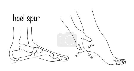 Heel spur. A bone growth that has the shape of a spike in the heel area. Pain in the leg due to the presence of a heel spur. Vector illustration.