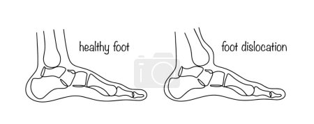 Téléchargez les illustrations : Déplacement du pied. Le résultat d'une blessure dans laquelle la relation des os dans l'articulation est perturbée et ils prennent une position atypique. Une jambe saine et une jambe avec un tibia déplacé. - en licence libre de droit