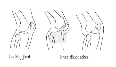 Dislocación saludable de rodilla y rodilla. Desplazamiento del fémur. Ilustración médica. Anatomía humana.