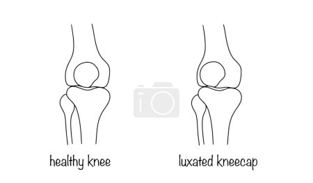 Articulación saludable de rodilla y rótula dislocada. Daño en el que la rótula se extiende más allá de los límites fisiológicos de la articulación de la rodilla. Ilustración vectorial.