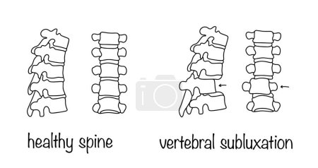 Vertebral subluxation. Partial displacement of a vertebra in the intervertebral joint. Healthy spine and spine with a problem. Simple medical illustration on a white background.