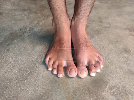 Photo for A Man Young Feet Bare, Male Fingernails, Indian Village Human Toenails, Hair, Skin, Foot, - Royalty Free Image
