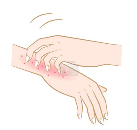 Das Kratzen der juckenden Hände Rötung Hautausschlag. Trockene Haut, Ekzeme, Dermatitis, Krätze, Verbrennungen, Narben, Hautausschlag, Insektenstiche und Nesselsucht. Gesundheitskonzept für die Haut