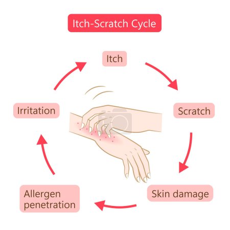 Téléchargez les photos : Gratter démangeaison cycle mains illustration. Sec, dermatite et eczéma atopique. Concept de soin de la peau sain - en image libre de droit