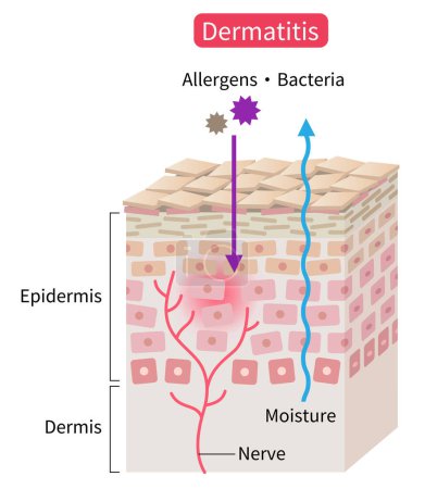 Téléchargez les photos : Illustration de la couche cutanée de dermatite atopique (eczéma). perturber la barrière d'humidité qui permet de pénétrer les stimuli externes. Concept de soin de la peau sain - en image libre de droit