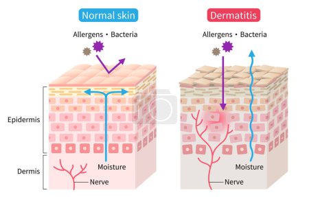 Téléchargez les photos : Dermatite atopique (eczéma) et illustration de la couche cellulaire cutanée normale. Concept de soin de la peau sain - en image libre de droit
