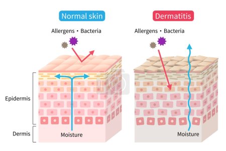 Téléchargez les photos : Atopic dermatitis (eczema) dry and normal skin cell layer  illustration. Before and after. Healthy and beauty skin care concept - en image libre de droit
