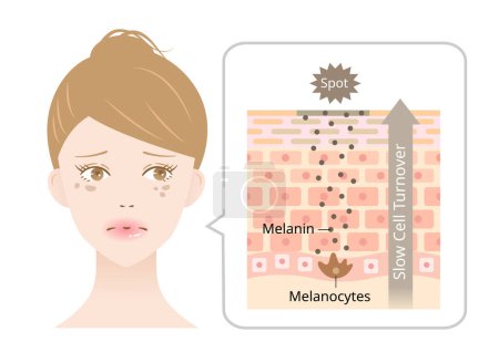 Illustration for Skin cell turnover and dark spots on young woman's face. melanin and melanocytes in human skin layer. Beauty and skin care concept - Royalty Free Image