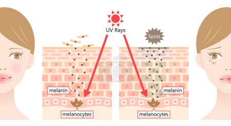 Illustration for Suns UV radiation induces dark spot by melanin on young womans face. Human skin layer and cell before after illustration. Beauty and health care concept - Royalty Free Image