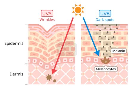 Ilustración de Daños UVA y UVB en la piel humana. Ultravioleta A (UVA) tiene una longitud de onda más larga. Se asocia con guiños. Ultravioleta B (UVB) tiene una longitud de onda más corta. Está asociado con la mancha oscura. Concepto de belleza y cuidado de salud - Imagen libre de derechos