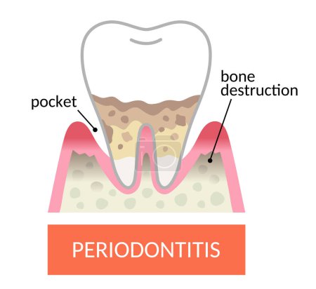periodontitis dental y encías. bolsillo periodontal y destrucción ósea. perder más hueso alrededor de los dientes y desarrollar bolsas periodontales. Concepto de cuidado dental y oral.