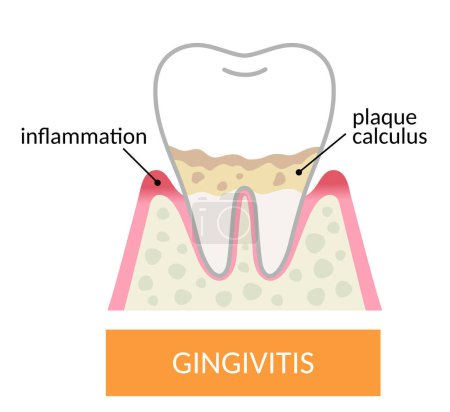 Ilustración de Gingivitis dientes y encías. placa y cálculo acumulan encías e inflamados. Concepto de salud dental y bucal - Imagen libre de derechos