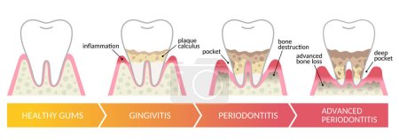 Les stades de la maladie parodontale. soins dentaires et buccodentaires concept