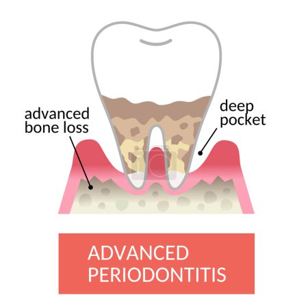 Illustration for Advanced periodontitis. periodontal pocket and bone destruction. destroyed bone cause teeth to become loose and fall out.   Dental and oral care concept. - Royalty Free Image