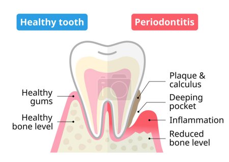 Ilustración de Diente sano y enfermedad periodontal. Concepto de cuidado de la salud dental y bucal. - Imagen libre de derechos