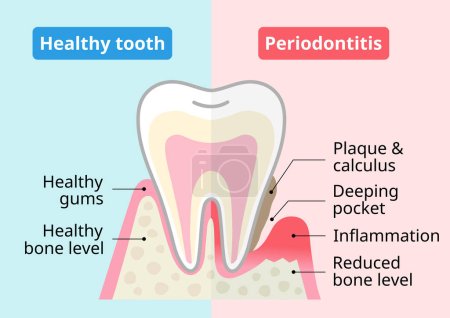 Ilustración de Diente sano y enfermedad periodontal. Concepto de cuidado de la salud dental y bucal. - Imagen libre de derechos