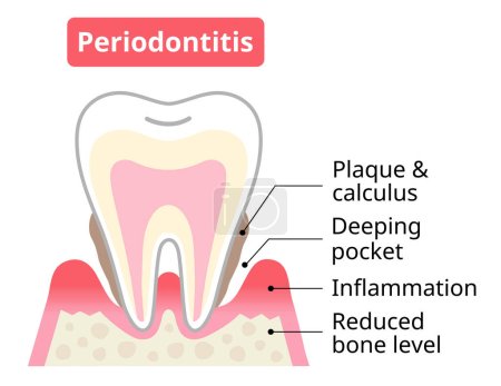 Ilustración de Periodontitis dientes y encías. Bolsillo periodontal y destrucción ósea. Concepto de cuidado dental y oral. - Imagen libre de derechos