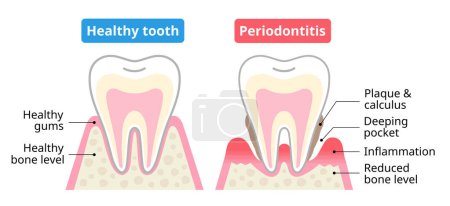 Téléchargez les illustrations : Dents saines et maladies parodontales. Concept de soins dentaires et buccodentaires. - en licence libre de droit