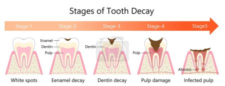 Etapas de la ilustración de la caries dental. Concepto de cuidado de la salud dental y bucal.