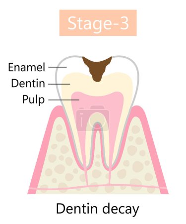 Illustration for Tooth decay symptom, dentin cavity. Dental and oral health care concept. - Royalty Free Image
