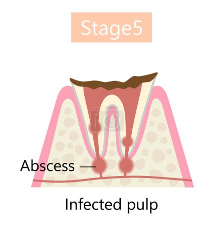 la etapa final de caries dental, formación de abscesos. Concepto de cuidado de la salud dental y bucal
