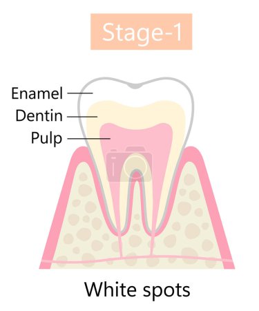 Téléchargez les illustrations : La première étape de la carie dentaire est la déminéralisation initiale. Concept de soins dentaires et buccodentaires - en licence libre de droit