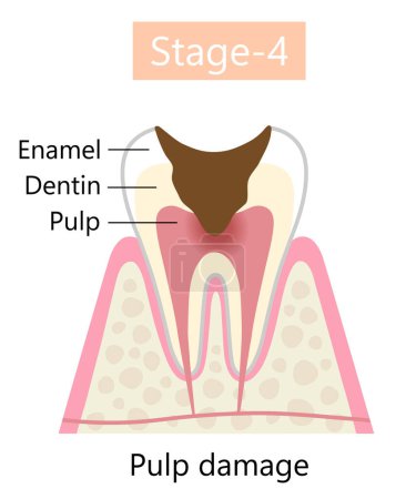 Síntoma de caries dental, daño por pulpa y. Concepto de cuidado de la salud dental y bucal.