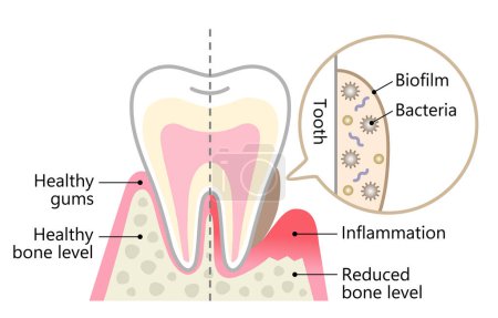 dental biofilm and healthy tooth. dental hygiene and health care concept