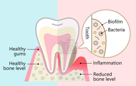dental biofilm and healthy tooth. dental hygiene and health care concept