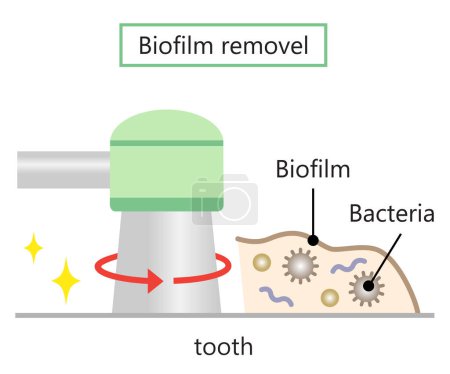 ilustración de remoción de biopelículas dentales. salud dental y concepto de cuidado bucal