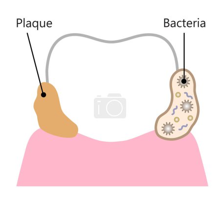 Bakterien und Plaque-Attachment am Zahn. Erste zahnärztliche Biofilmillustration. Zahngesundheit und Mundpflege